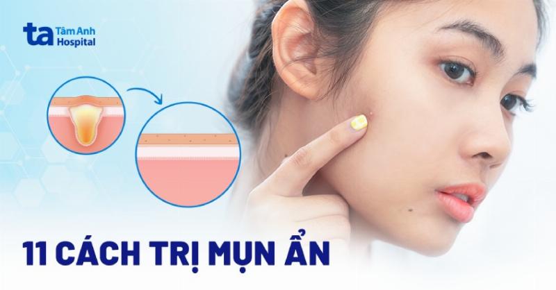 Cách sử dụng sữa rửa mặt cho da mụn ẩn hiệu quả