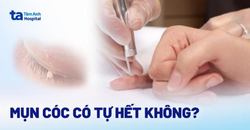 Các loại cóc 3 chân phổ biến