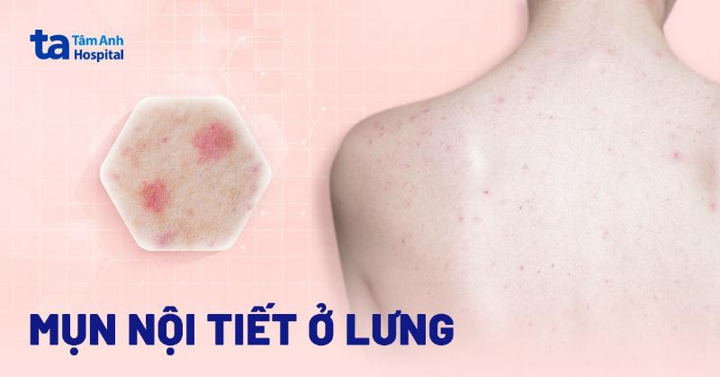 Lưu ý khi sử dụng xà phòng trị mụn lưng