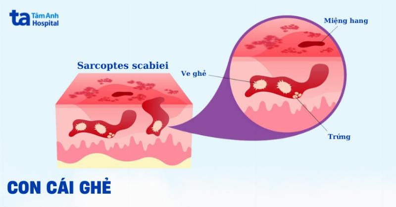 Nhộng ve chó 8 chân: Nhộng ve đã phát triển đủ 8 chân