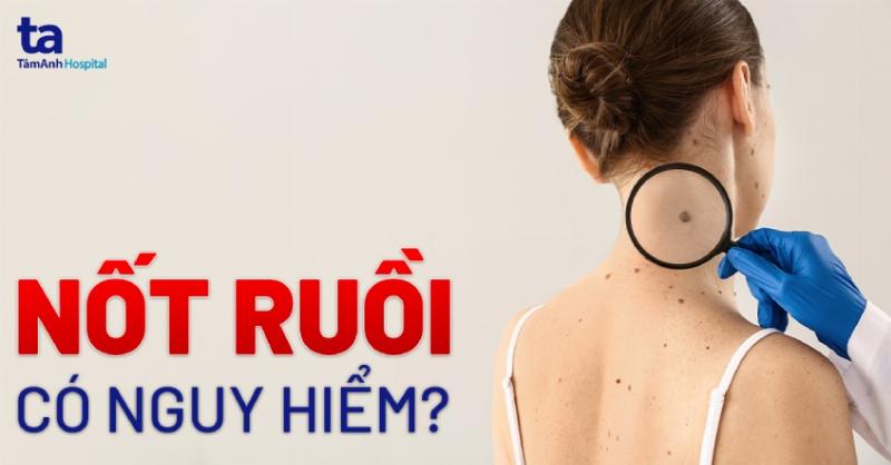 Nốt ruồi cổ tay trái nữ: Kích thước lớn hay nhỏ?