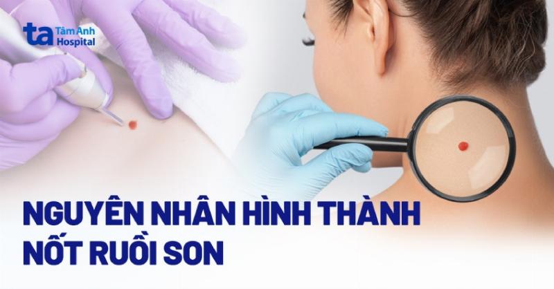 Nốt ruồi cổ tay trái nữ: Đen, đỏ, nâu