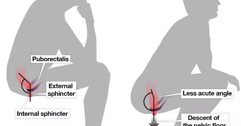 Tư thế ngồi xổm khi đi vệ sinh